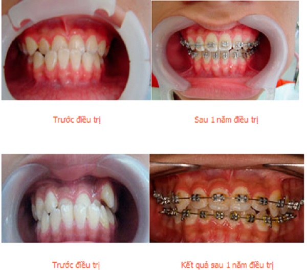 Niềng răng khắc phục hiệu quả vấn đề hàm răng bị sai lệch