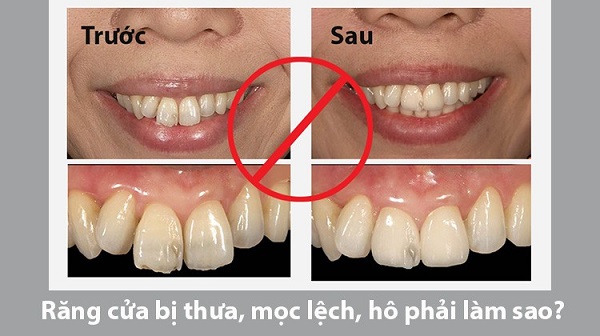 Răng cửa bị lệch là gì?