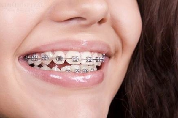 Phương pháp niềng răng bằng mắc cài kim loại