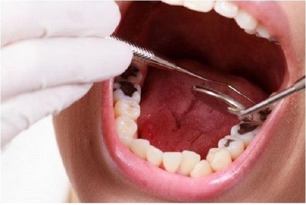 Trám răng sâu là phương pháp được sử dụng nhiều hiện nay