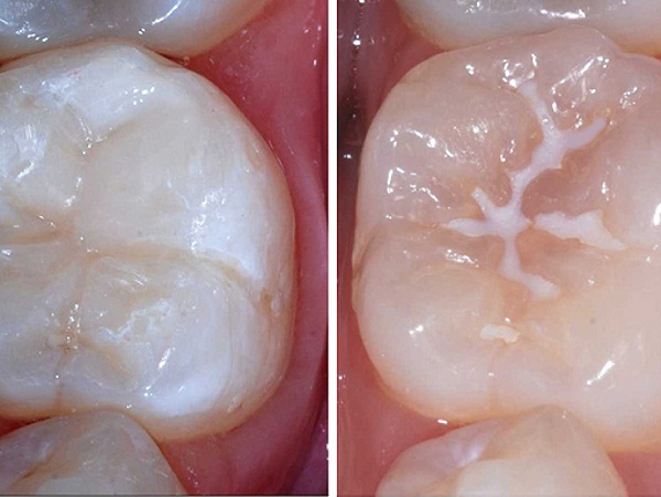 Phương pháp trám bít hố răng sâu rất hiệu quả