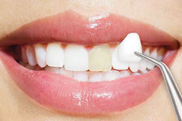 Tuổi thọ của răng sứ Veneer là bao nhiêu?
