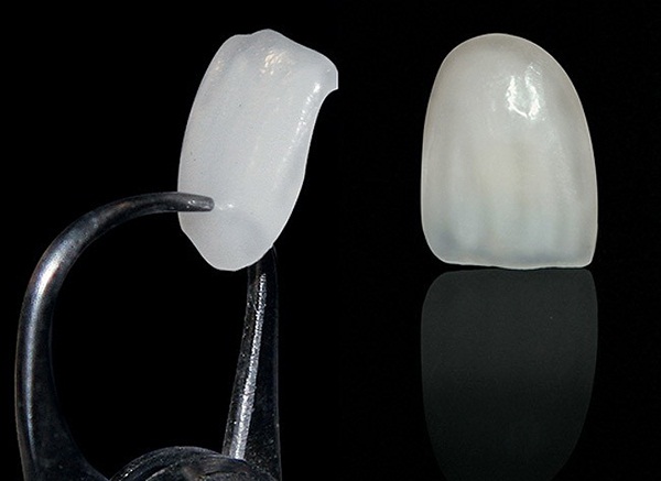 Miếng dán răng sứ Veneer có độ bền cao
