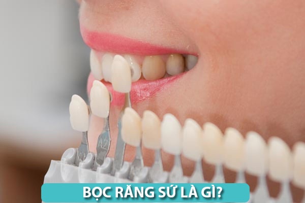 Ưu điểm của bọc răng sứ thẩm mỹ