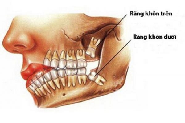 Liệu bạn đã biết răng số 8 mọc ở vị trí cuối cùng ở mỗi góc hàm?