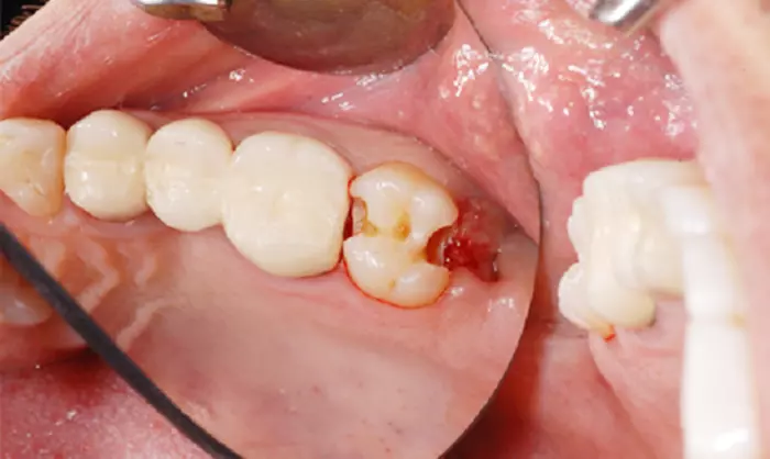 Răng số 8 đóng vai trò quan tham gia chức năng nghiền nát thức ăn.