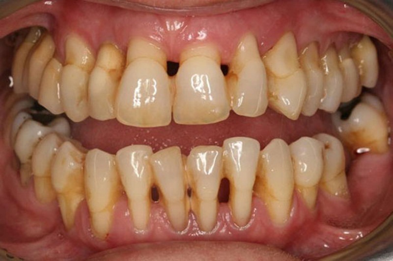 Bệnh về miệng: Bệnh nha chu