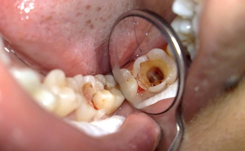 Tủy răng hoại tử - bệnh răng miệng nguy hiểm