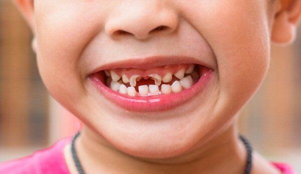 Bệnh lý sâu răng rất thường gặp ở trẻ em
