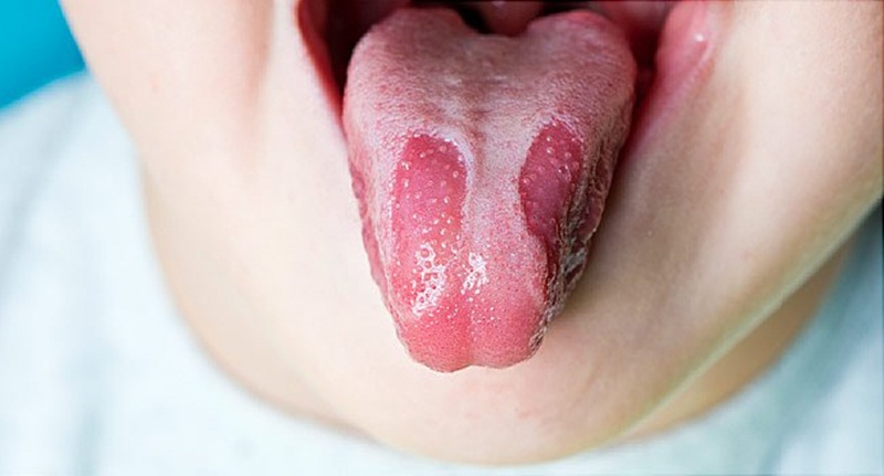 Bệnh lý viêm lưỡi bản đồ ở trẻ em