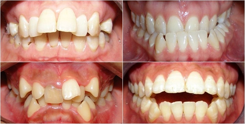 Tình trạng răng mọc lệch lạc, hô, móm
