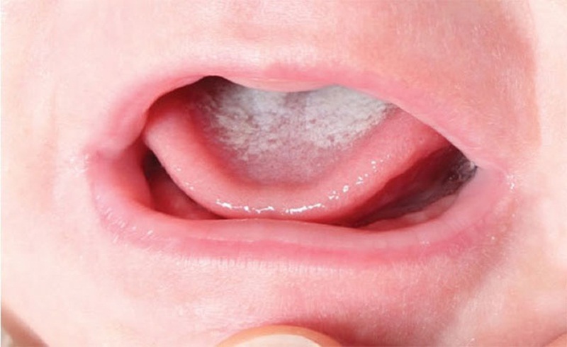 Tưa lưỡi ở trẻ em – căn bệnh cực kỳ nguy hiểm