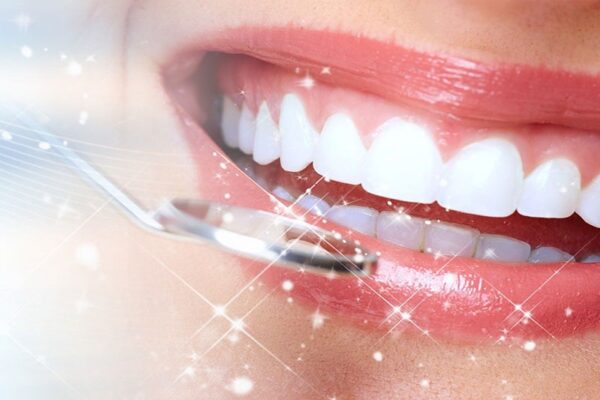 Thẩm mỹ răng thưa bằng mặt dán sứ Veneer có tốt không?