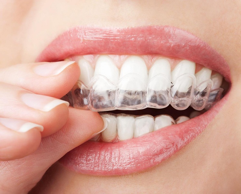 Niềng răng Invisalign có phải là giải pháp chỉnh nha tối ưu?