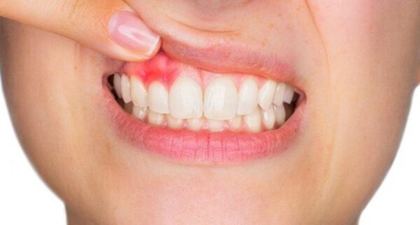 Viêm nha chu xuất hiện phổ biến ở nhiều người Việt