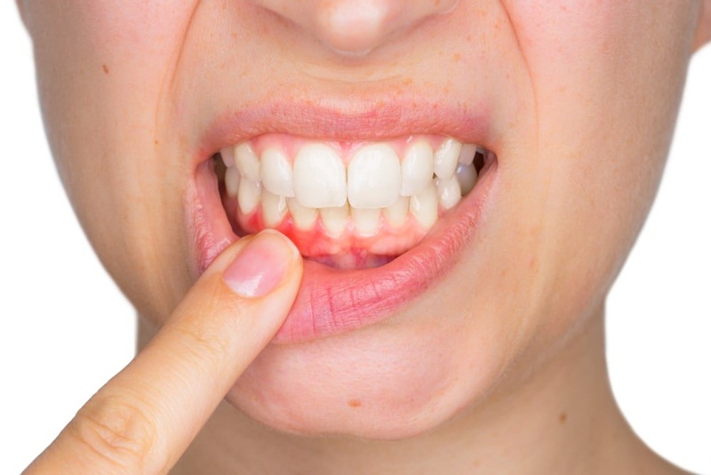 Có những phương pháp điều trị bệnh viêm nha chu nào?