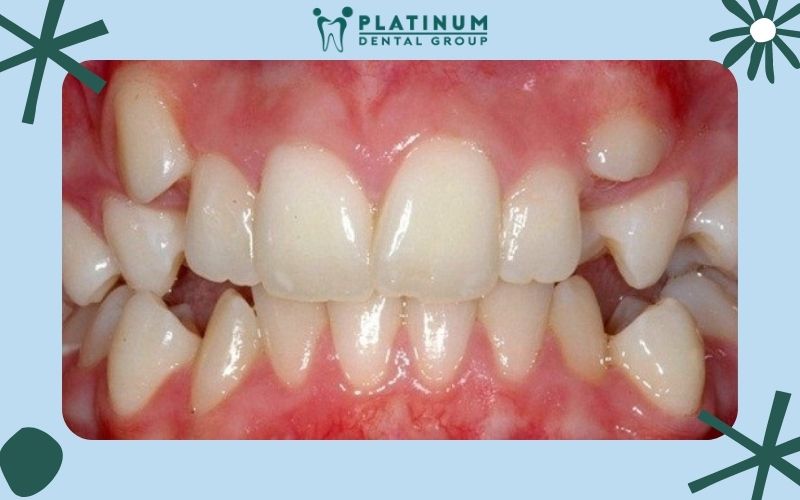 Khái niệm răng mọc thừa là gì ?