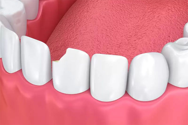 Biến chứng khôn lường khi răng sứ bị vỡ