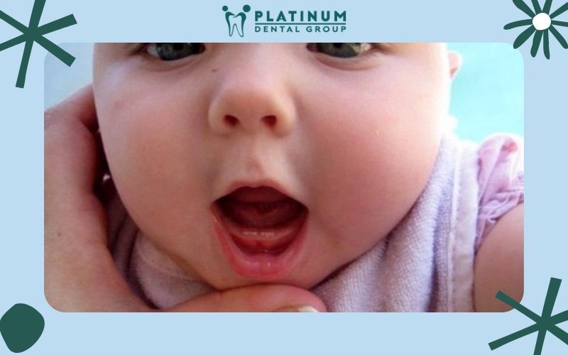 Răng sữa là răng tạm thời xuất hiện khi trẻ còn nhỏ