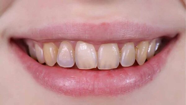 Men răng yếu có thể do di truyền hoặc chăm sóc không đúng cách