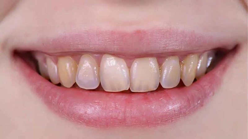 Men răng yếu có thể do di truyền hoặc chăm sóc không đúng cách