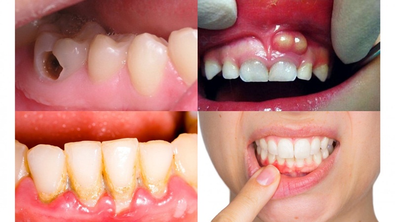 Các bệnh lý răng miệng liên quan cần phải được điều trị trước khi trồng răng
