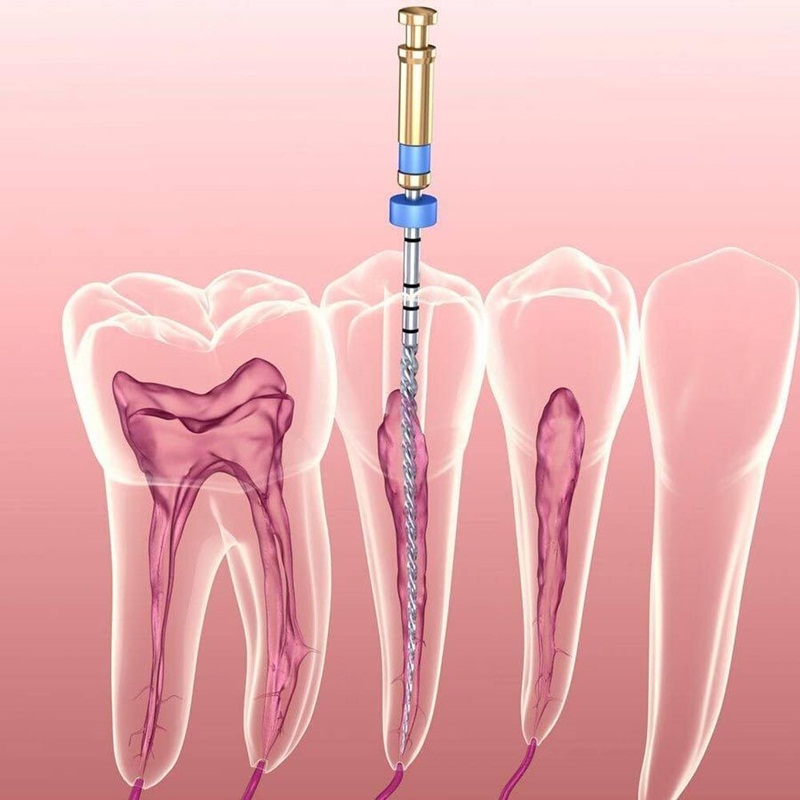 Điều trị tủy dứt điểm, triệt để cũng là vấn đề phải lưu ý