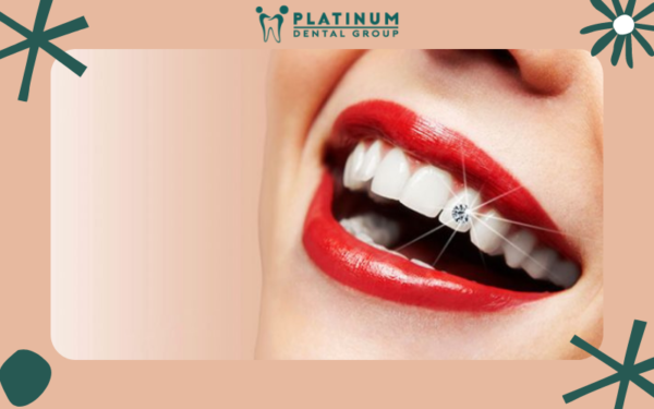 Làm răng đính kim cương có thực sự tốt?