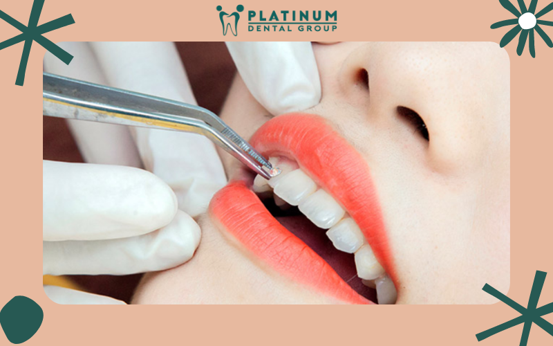 Những câu hỏi thường gặp khi đính đá kim cương lên răng