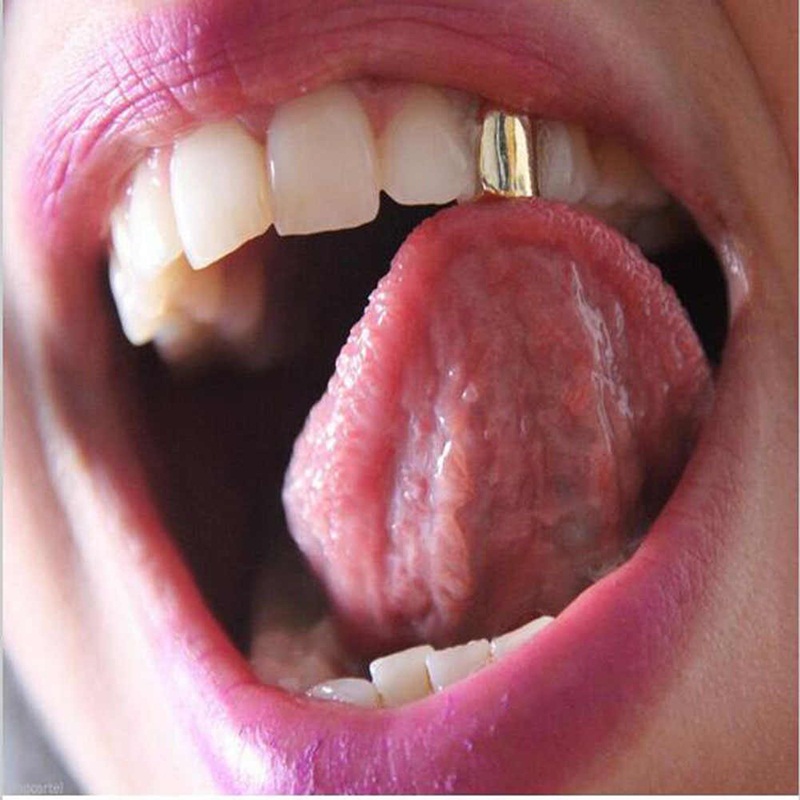 Những lưu ý khi làm răng mạ vàng là gì?