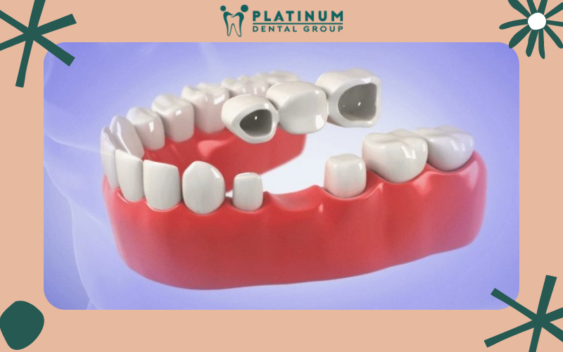 Các phương pháp khắc phục tình trạng răng giả gây hôi miệng hiệu quả