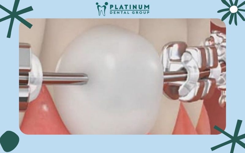Ưu điểm và nhược điểm của sáp nha khoa