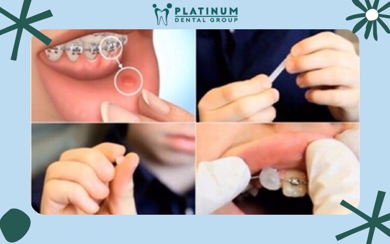 Hướng dẫn sử dụng sáp nha khoa đúng cách