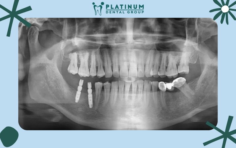 Vai trò quan trọng của X Quang nha khoa