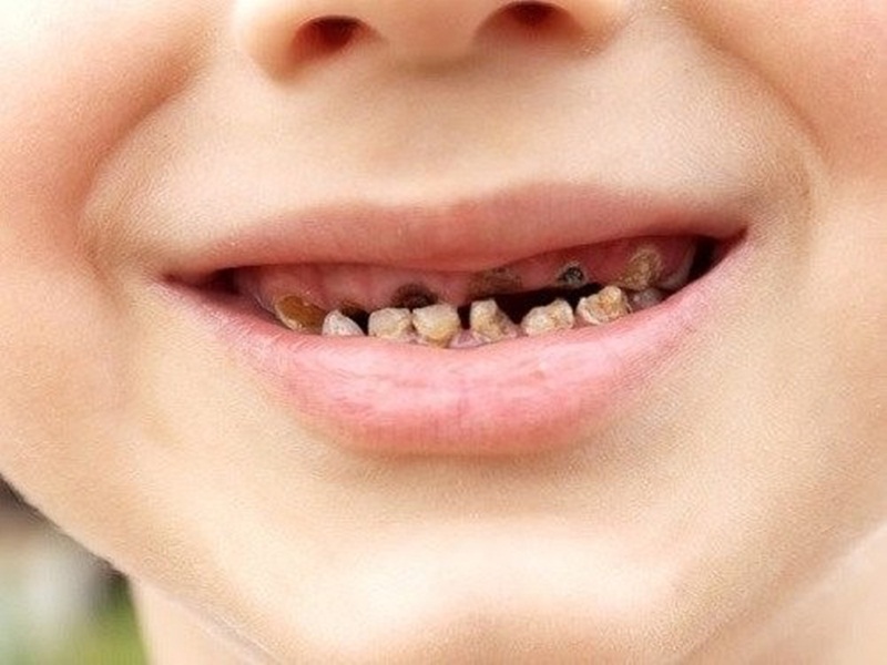 Những nguyên nhân dẫn đến răng bị xiết ăn của trẻ?