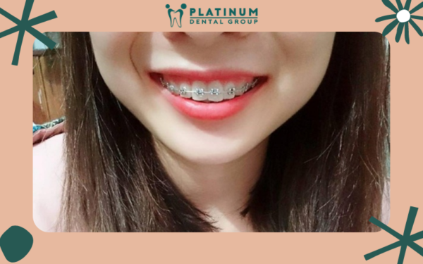 Mắc cài kim loại là dạng phổ biến nhất