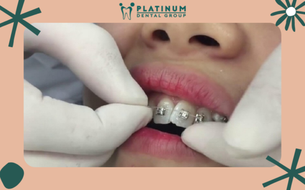 Niềng răng bị đau ê do kỹ thuật chỉnh nha không đảm bảo