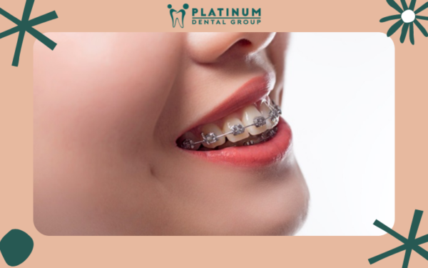Niềng răng giúp răng đẹp hơn, thay đổi ngoại hình