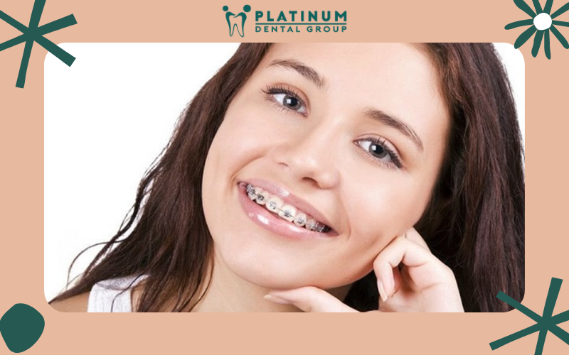 Niềng răng giúp đẹp và tự tin hơn