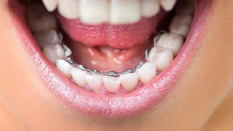 Niềng răng cài mắc trong