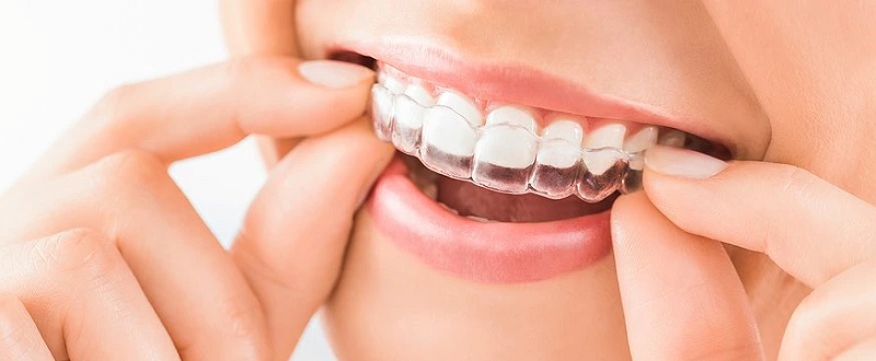 Niềng răng trong suốt Invisalign