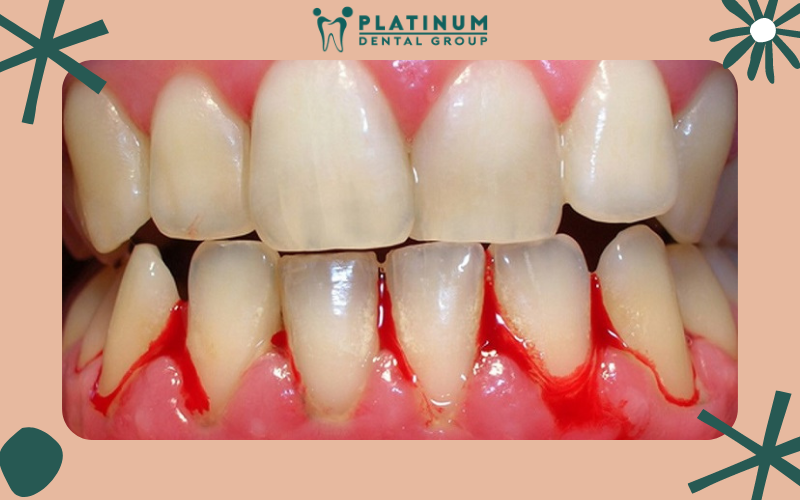 Bệnh chảy máu chân răng là gì? Bệnh chảy máu chân răng là gì?