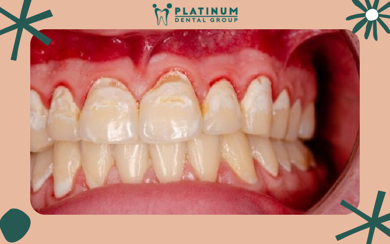 Những phương pháp điều trị hiệu quả bệnh chảy máu chân răng Những phương pháp điều trị hiệu quả bệnh chảy máu chân răng