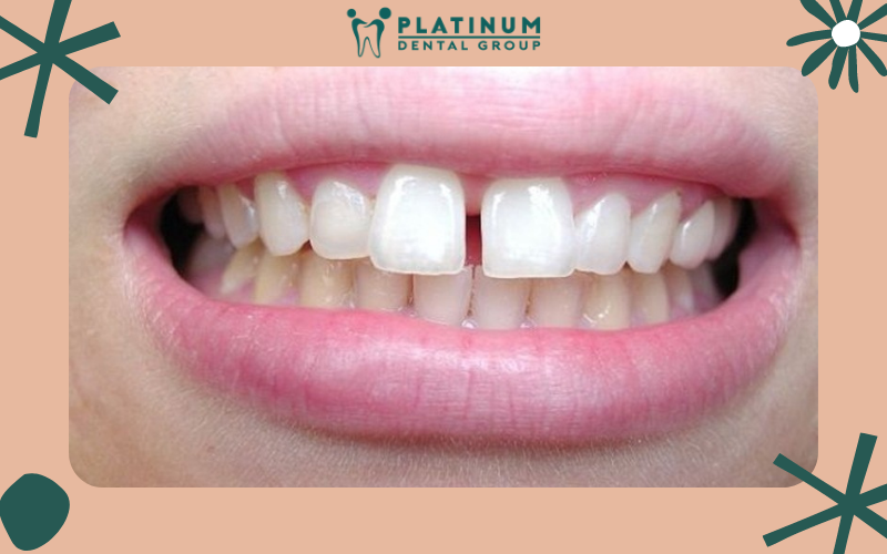 Hàm răng xấu xí mất thẩm mỹ Hàm răng xấu xí mất thẩm mỹ