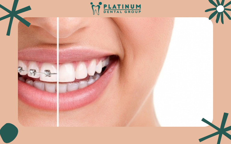 Niềng 2 răng cửa như thế nào là hợp lý nhất? Niềng 2 răng cửa như thế nào là hợp lý nhất?