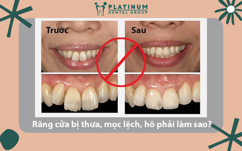 Thời gian niềng răng bị chi phối bởi nhiều yếu tố Thời gian niềng răng bị chi phối bởi nhiều yếu tố