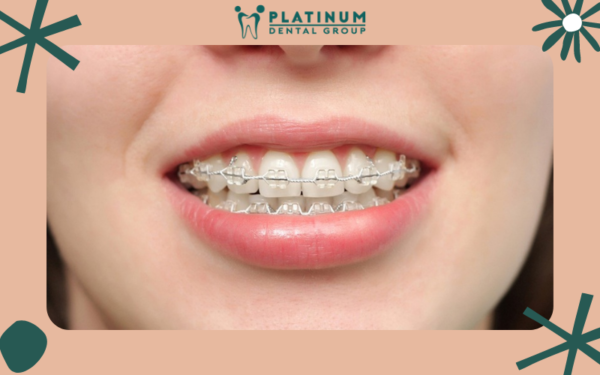 Phương pháp niềng răng mắc cài sứ