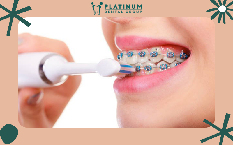 Chải răng đúng cách để không gây ảnh hưởng đến mắc cài Chải răng đúng cách để không gây ảnh hưởng đến mắc cài
