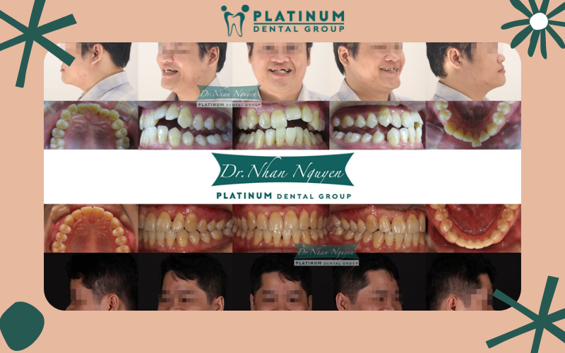Sở hữu hàm răng đều, đẹp với sự hỗ trợ của Nha Khoa Platinum Sở hữu hàm răng đều, đẹp với sự hỗ trợ của Nha Khoa Platinum