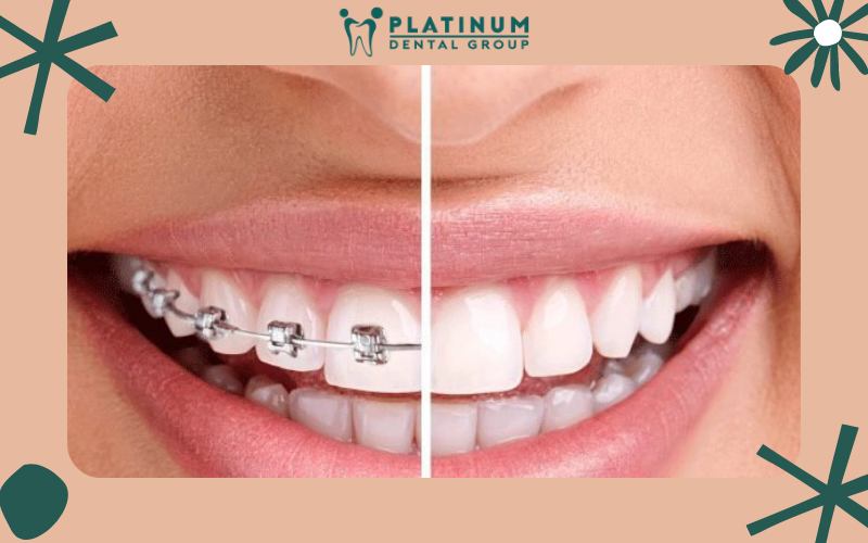 Niềng răng bao lâu mới có thể tháo?
